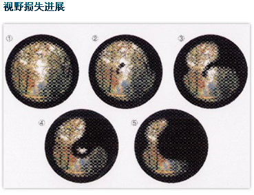 视力损失进展