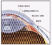 闭角型青光眼
